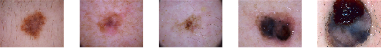 Melanoma